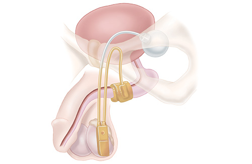 Artificial Urinary Sphincter - Keystone Urology Specialists