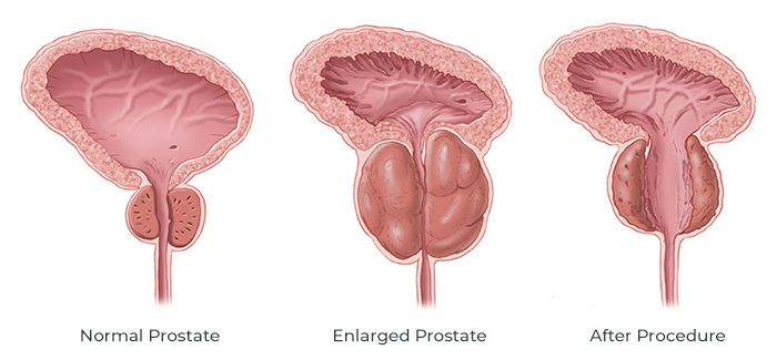turul prostatei